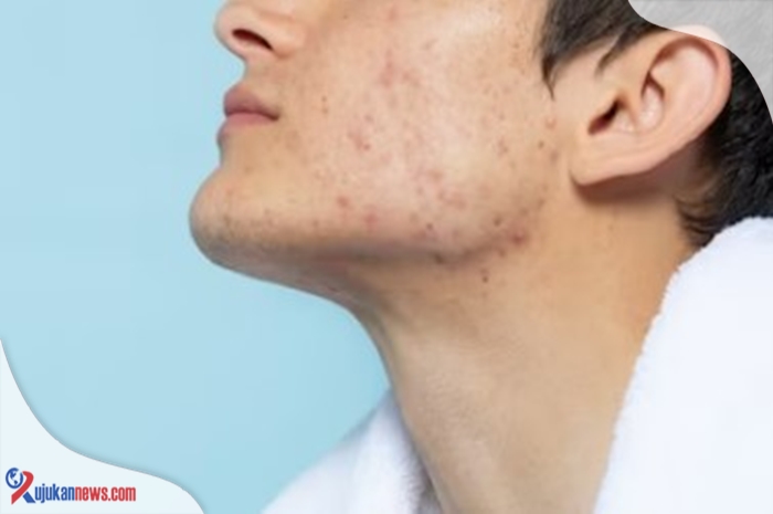 ¡11 formas de deshacerse del acné quístico para que no se ponga negro!